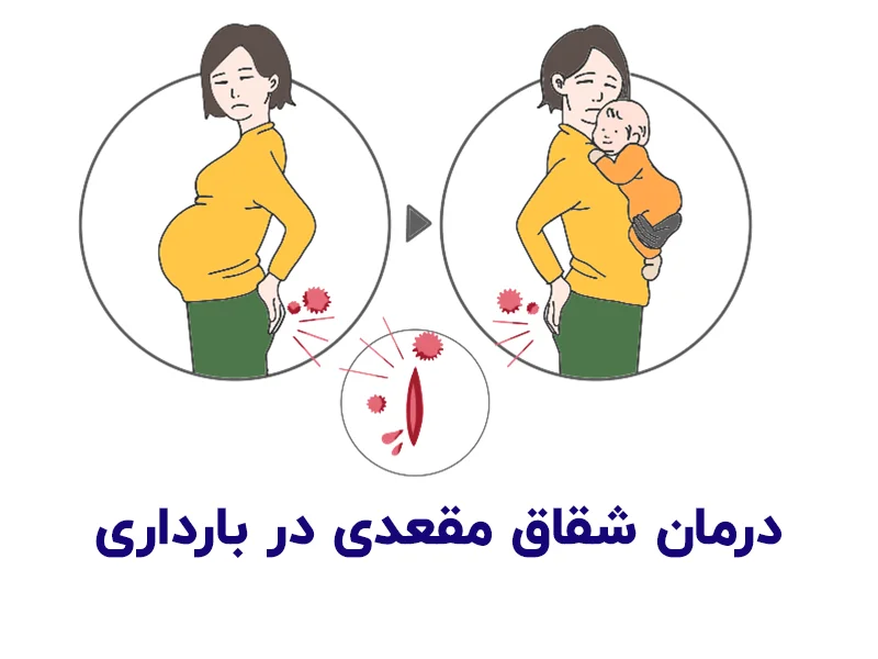 درمان-شقاق-مقعدی-در-بارداری